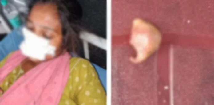 میکے سے واپس نہ آنے پر شوہر نے مبینہ طور پر بیوی کی ناک کاٹ دی